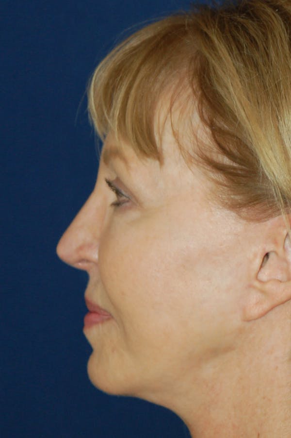 Chin & Cheek Augmentation Before & After Gallery - Patient 10380365 - Image 4