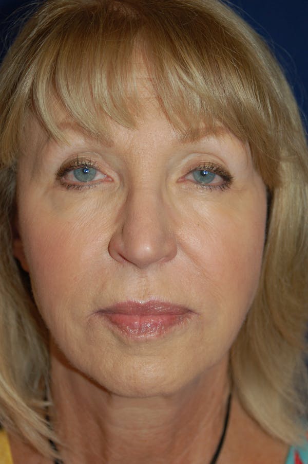 Facelift Before & After Gallery - Patient 10131843 - Image 1