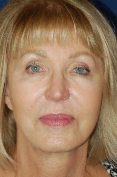 Facelift Before & After Gallery - Patient 10131843 - Image 2