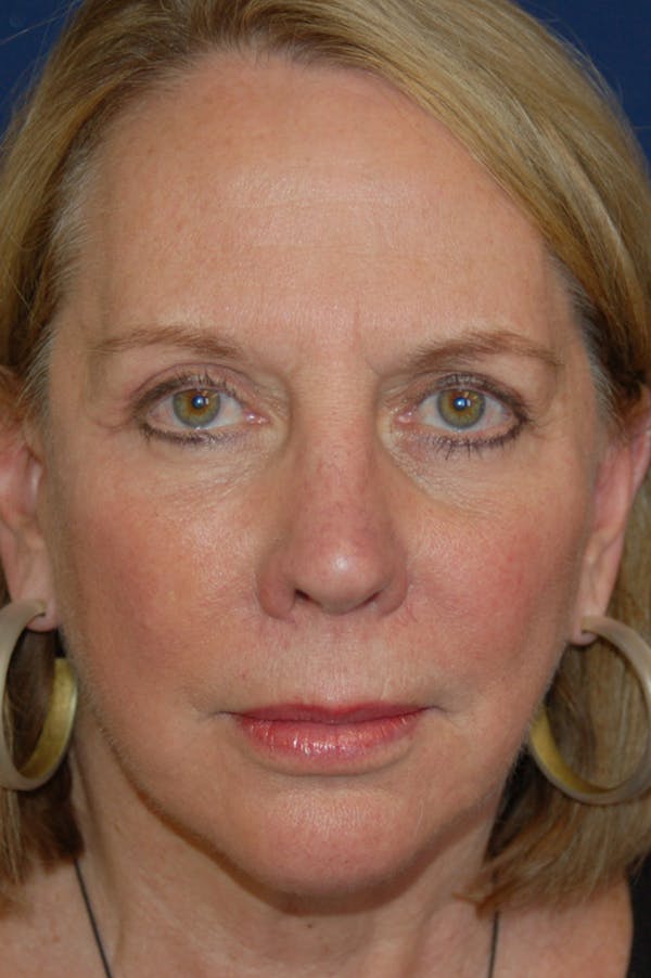 Facelift Before & After Gallery - Patient 10131853 - Image 2