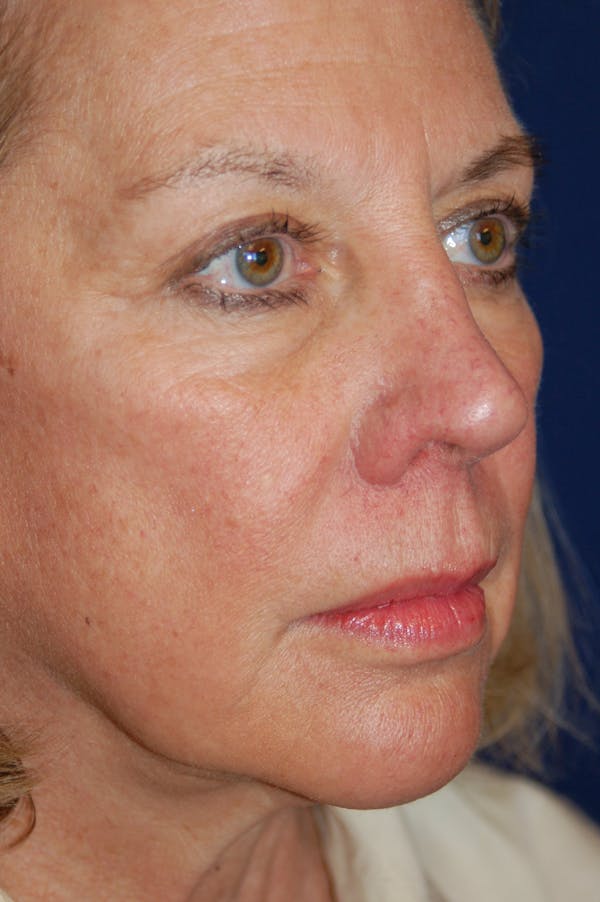 Facelift Before & After Gallery - Patient 10131853 - Image 3