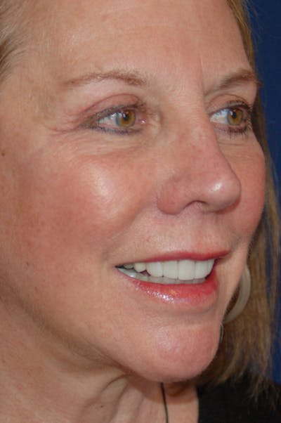 Facelift Before & After Gallery - Patient 10131853 - Image 4