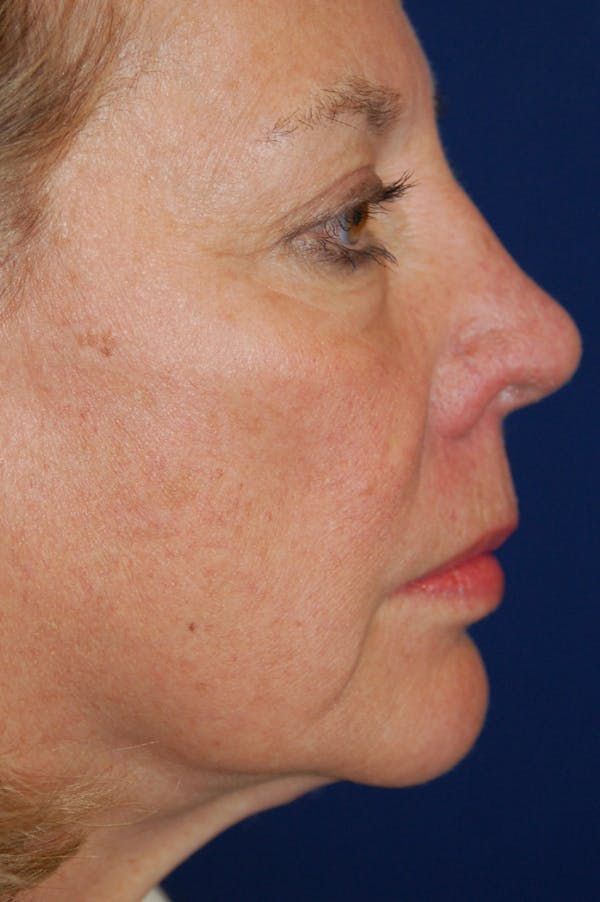 Facelift Before & After Gallery - Patient 10131853 - Image 5