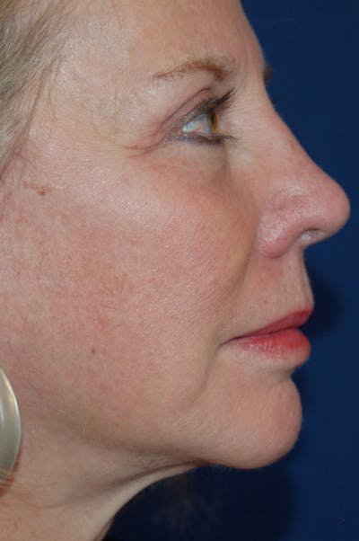 Facelift Before & After Gallery - Patient 10131853 - Image 6