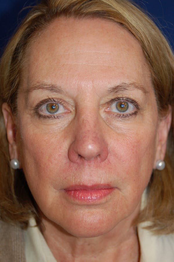 Facelift Before & After Gallery - Patient 10131853 - Image 1