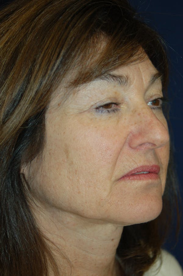 Eyelid Surgery Before & After Gallery - Patient 10380340 - Image 3