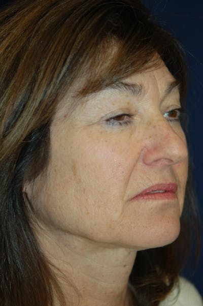Facelift Before & After Gallery - Patient 10131854 - Image 1