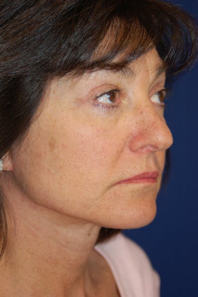 Facelift Before & After Gallery - Patient 10131854 - Image 2