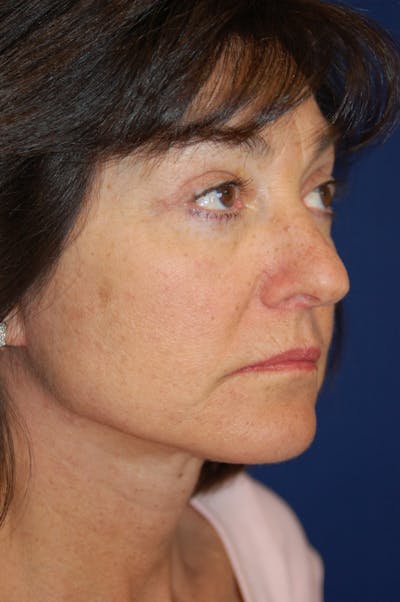 Eyelid Surgery Before & After Gallery - Patient 10380340 - Image 4