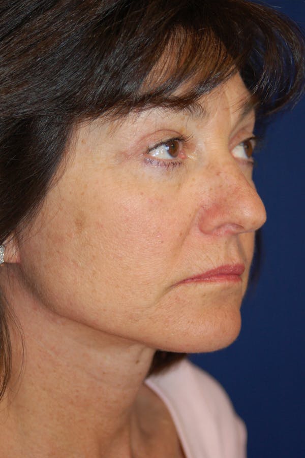 Facelift Before & After Gallery - Patient 10131854 - Image 2