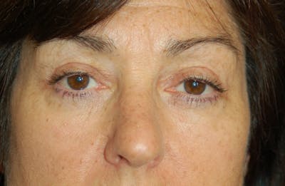 Facelift Before & After Gallery - Patient 10131854 - Image 4