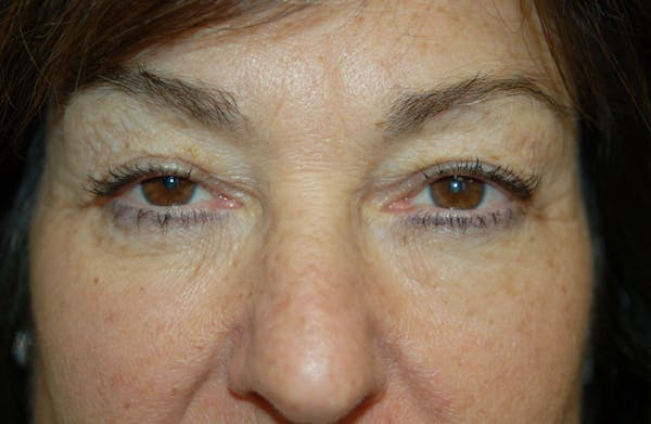 Eyelid Surgery Before & After Gallery - Patient 10380340 - Image 1