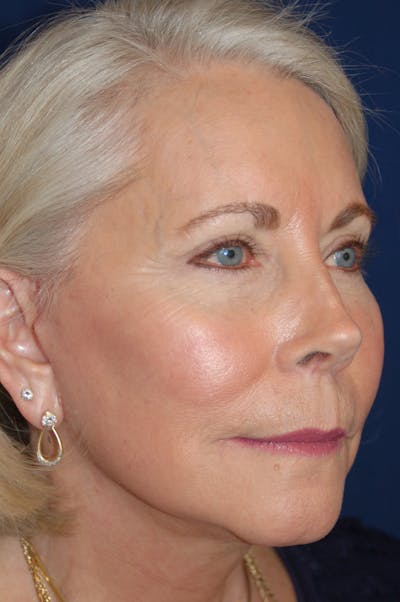 Facelift Before & After Gallery - Patient 10131855 - Image 2