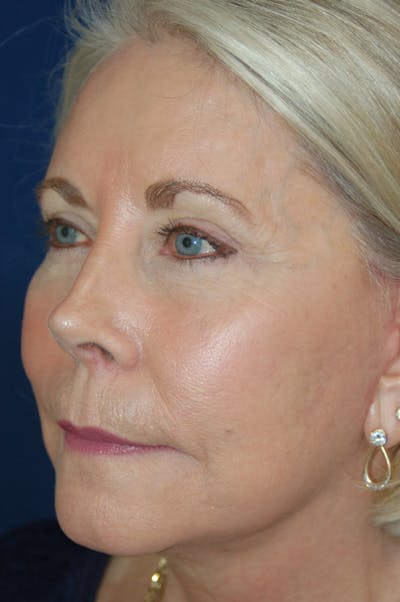 Facelift Before & After Gallery - Patient 10131855 - Image 4