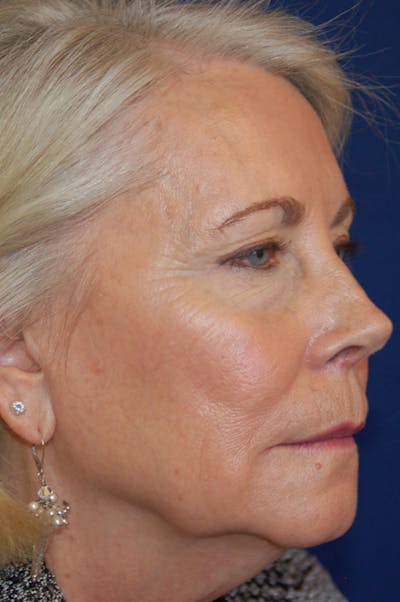 Eyelid Surgery Before & After Gallery - Patient 10380343 - Image 1