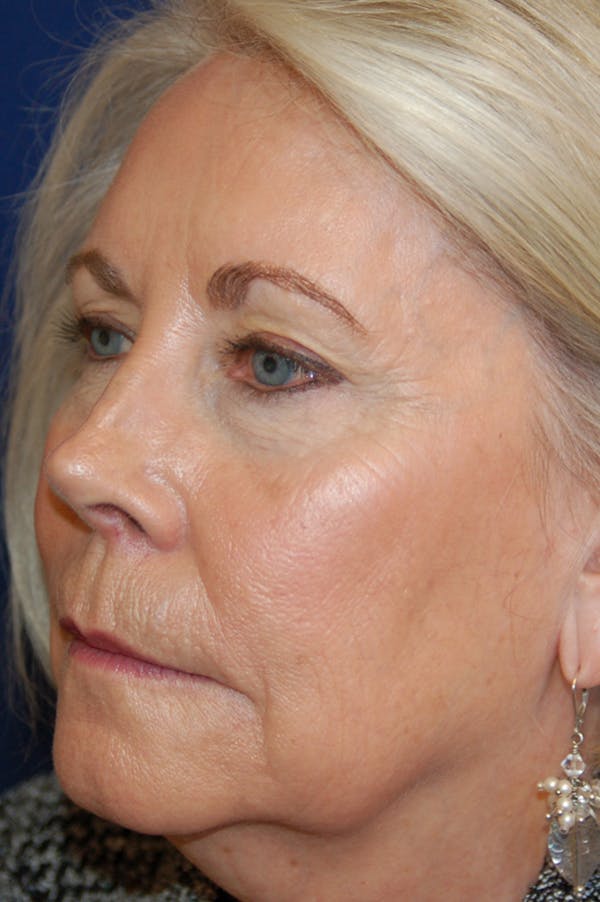 Facelift Before & After Gallery - Patient 10131855 - Image 3