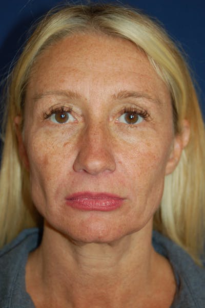 Facelift Before & After Gallery - Patient 10131869 - Image 1