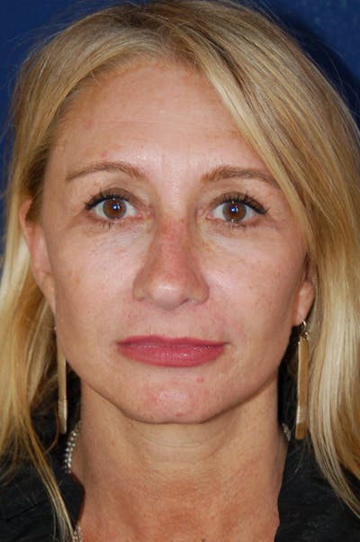 Facelift Before & After Gallery - Patient 10131869 - Image 2