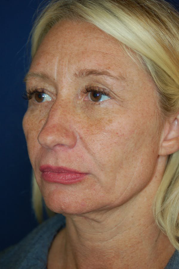 Eyelid Surgery Before & After Gallery - Patient 10131906 - Image 3