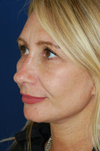 Facelift Before & After Gallery - Patient 10131869 - Image 4