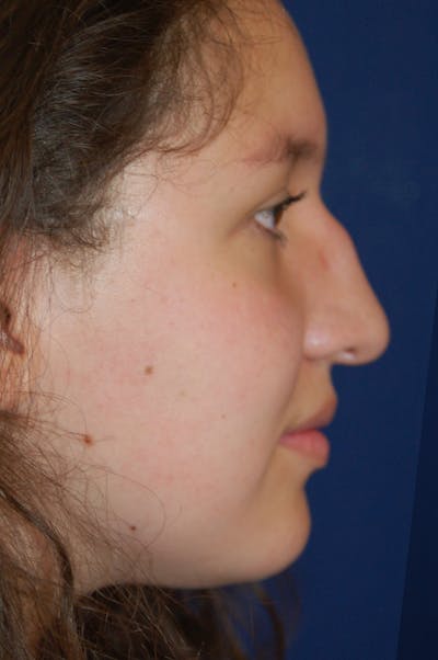 Rhinoplasty Before & After Gallery - Patient 10131883 - Image 1