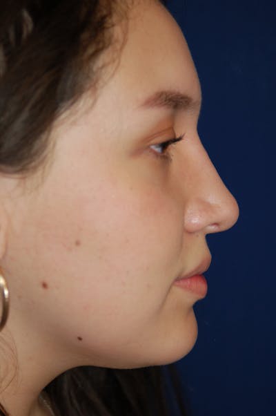 Rhinoplasty Before & After Gallery - Patient 10131883 - Image 2