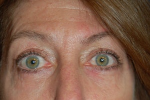 Eyelid Surgery
