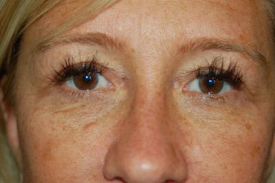 Eyelid Surgery Gallery - Patient 10131906 - Image 1