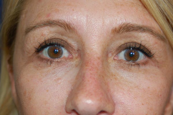 Eyelid Surgery Before & After Gallery - Patient 10131906 - Image 2