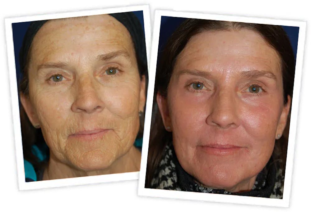 Chemical Peel / Skin Resurfacing Before & After Gallery - Patient 11264560 - Image 1