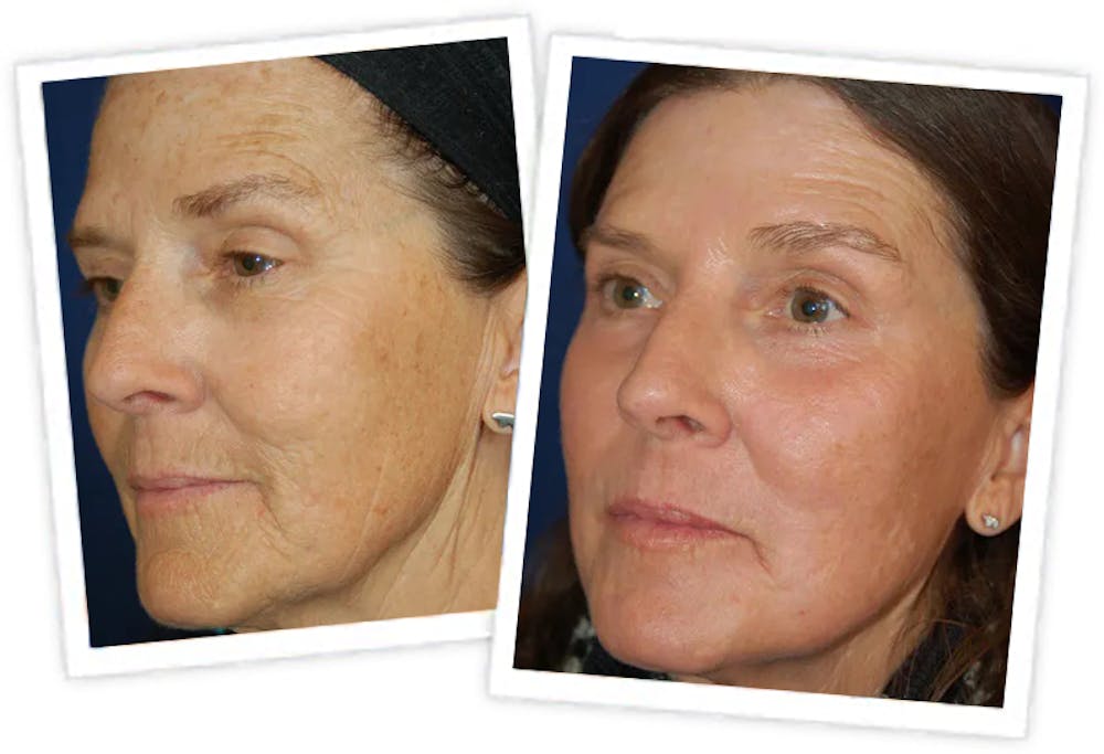 Chemical Peel / Skin Resurfacing Before & After Gallery - Patient 11264560 - Image 2