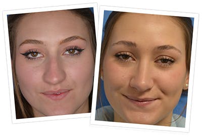 Rhinoplasty Before & After Gallery - Patient 144686998 - Image 1
