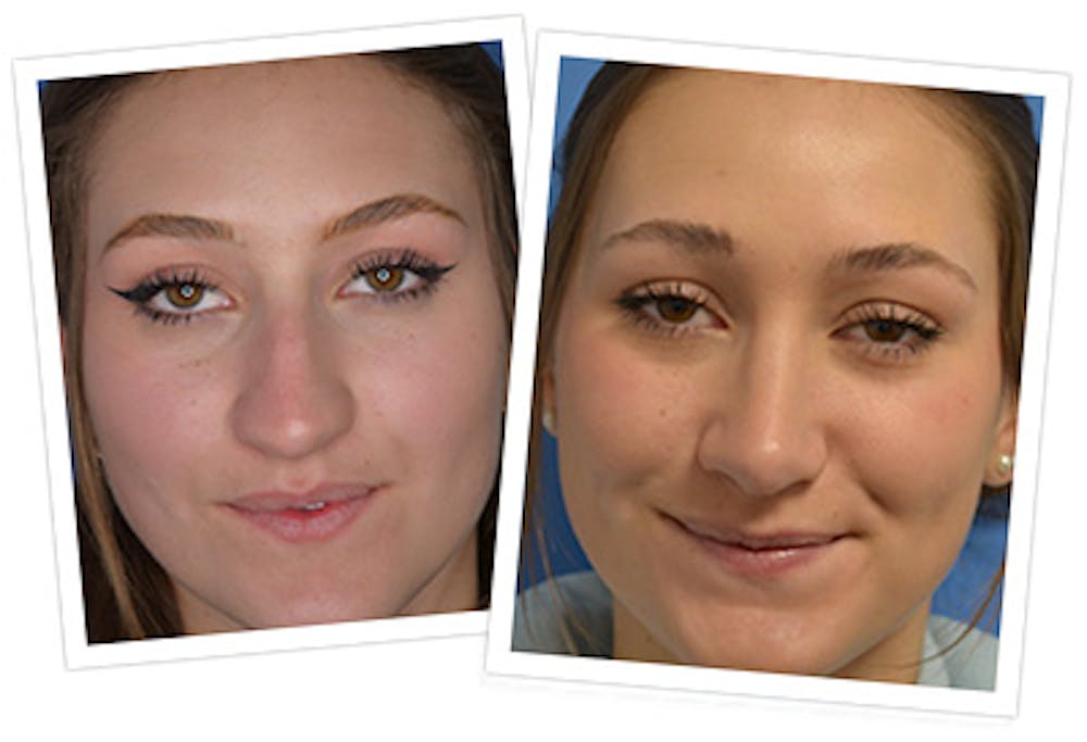 Rhinoplasty Before & After Gallery - Patient 144686998 - Image 1