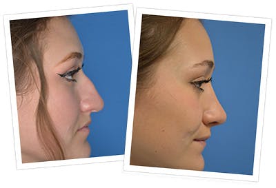 Rhinoplasty Before & After Gallery - Patient 144686998 - Image 2
