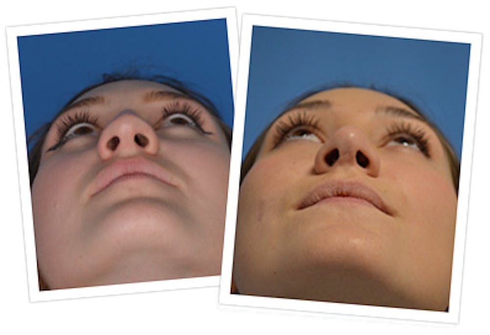 Rhinoplasty Before & After Gallery - Patient 144686998 - Image 3