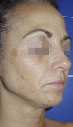 Cosmelan Peel