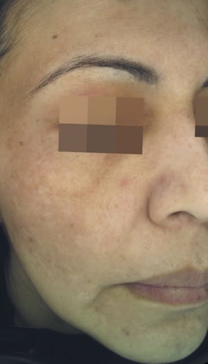 Cosmelan Peel