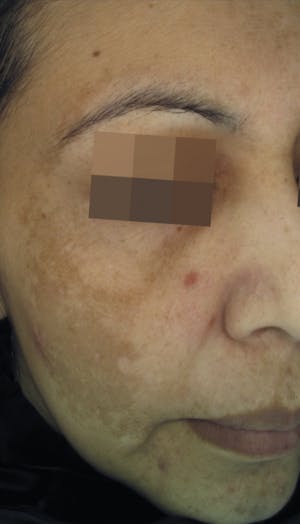 Cosmelan Peel