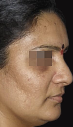 Cosmelan Peel