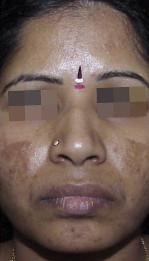 Cosmelan Peel