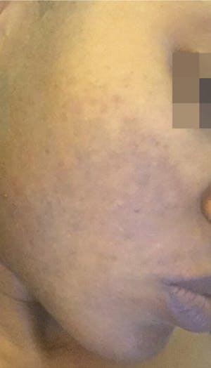 Cosmelan Peel