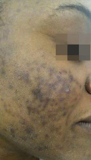 Cosmelan Peel