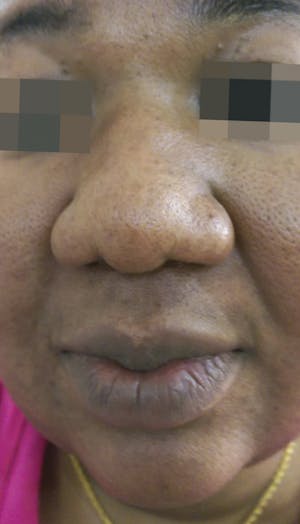 Cosmelan Peel