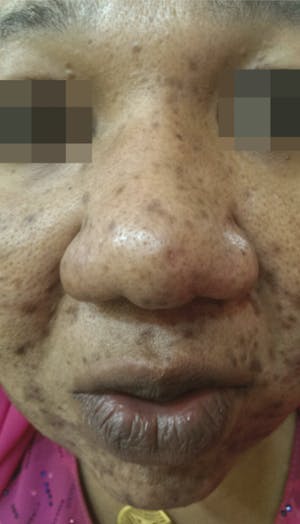 Cosmelan Peel