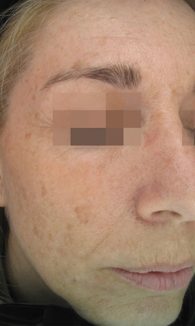 Cosmelan Peel Before & After Gallery - Patient 145355989 - Image 1