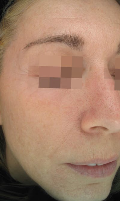 Cosmelan Peel Before & After Gallery - Patient 145355989 - Image 2