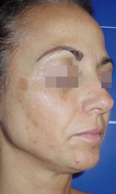 Cosmelan Peel Before & After Gallery - Patient 145355990 - Image 1