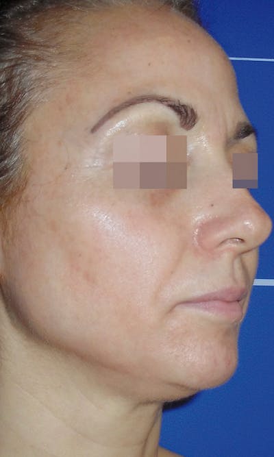 Cosmelan Peel Before & After Gallery - Patient 145355990 - Image 2