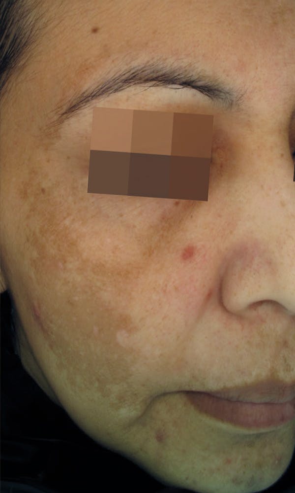 Cosmelan Peel Before & After Gallery - Patient 145355991 - Image 1