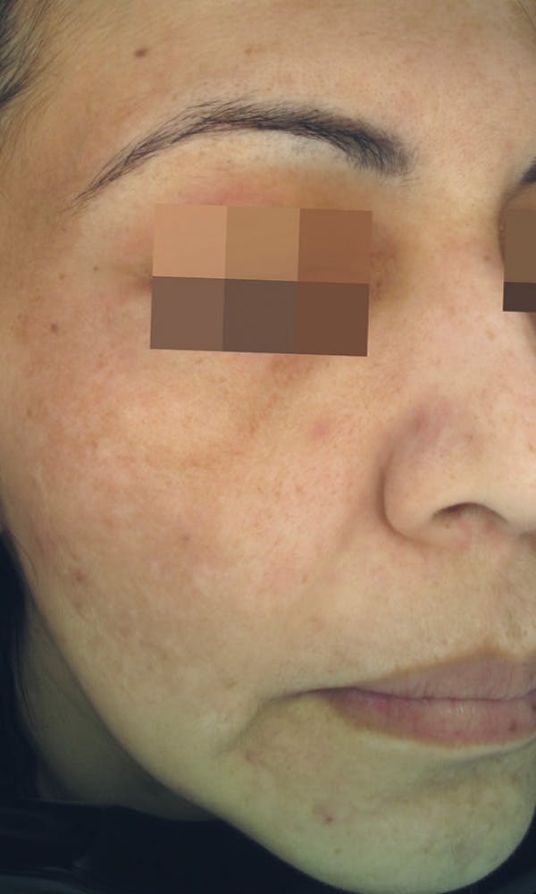 Cosmelan Peel Before & After Gallery - Patient 145355991 - Image 2